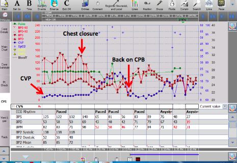 File:Crash onto CPB after chest closure.png