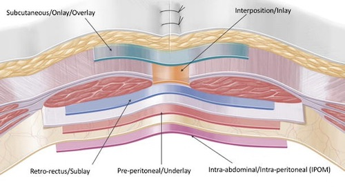 File:Mesh Placement Techniques.png