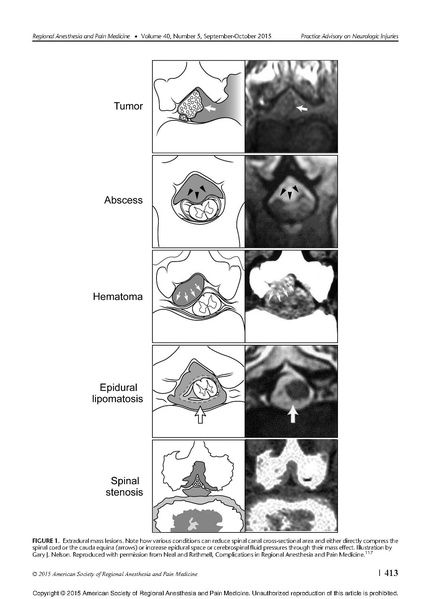 File:2015 ASRA advaisory of neurologic injury.pdf