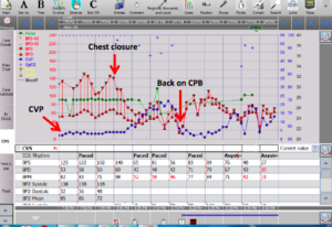 Crash onto CPB after chest closure.png