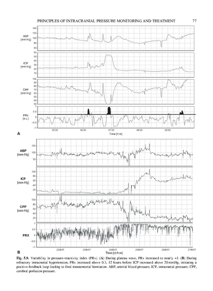 File:Czosnyka 2017 Handbook of Clin Neurology - Increased ICP Management.pdf