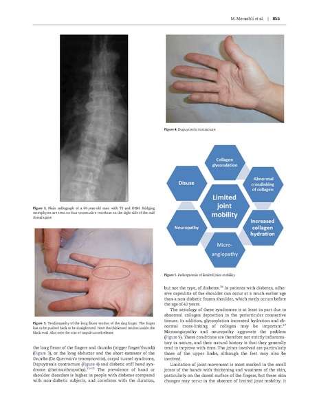 File:DM and musculoskeletal Merashli QJM 2015.pdf