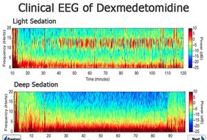 Dexmedetomidine EEG.jpg