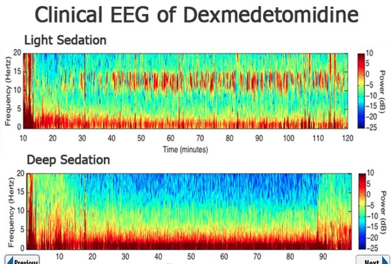 File:Dexmedetomidine EEG.jpg