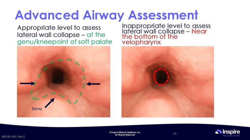 File:Drug Induced Sleep Endoscopy.pdf
