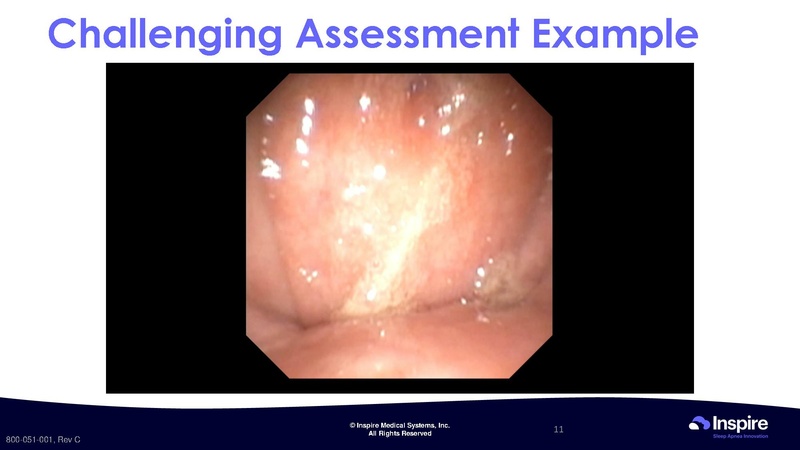 File:Drug Induced Sleep Endoscopy.pdf