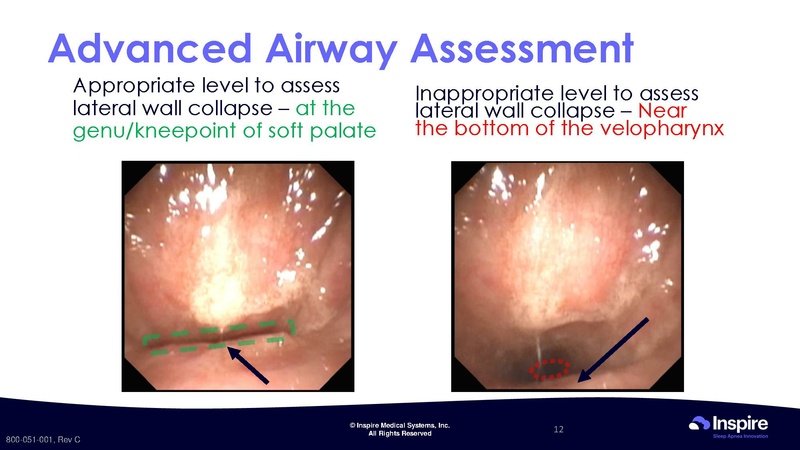 File:Drug Induced Sleep Endoscopy.pdf