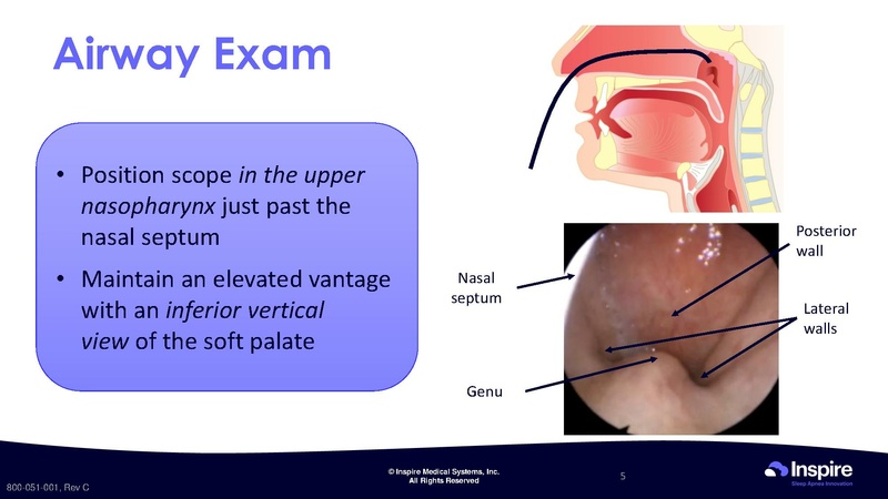 File:Drug Induced Sleep Endoscopy.pdf