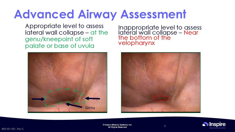 File:Drug Induced Sleep Endoscopy.pdf