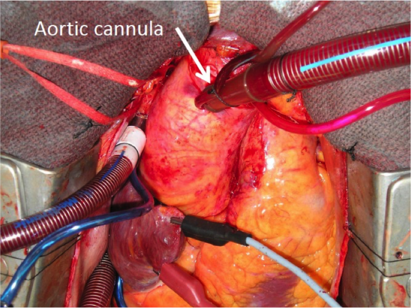 File:Figure 1 aortic cannula.png