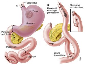 Gastric 1.jpg