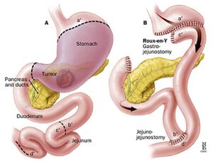 Gastric 2.jpg