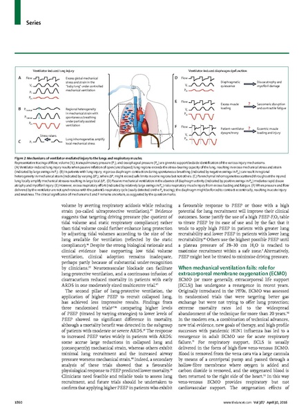File:Goligher 2016 Lancet - Guides to ventilation.pdf