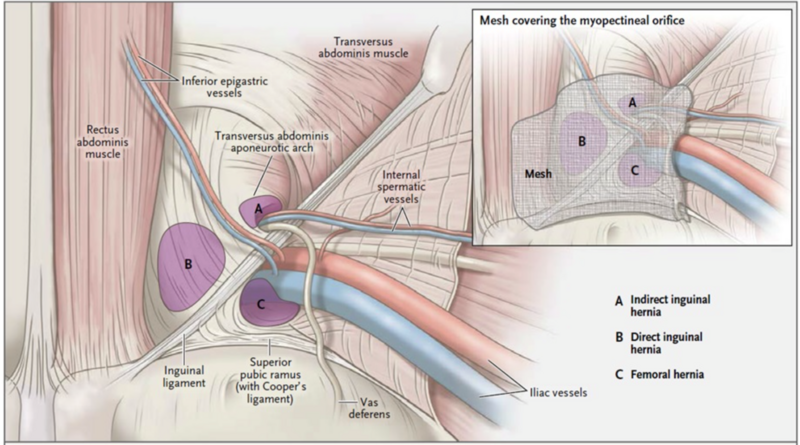 File:Hesselbach's Triangle.png