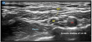 Interscalene catheter.png