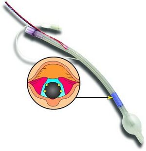 Monitoring ETT for parathyroid surgery.jpg