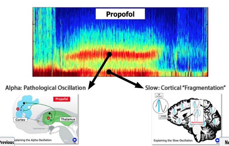 File:Propofol EEG.jpg