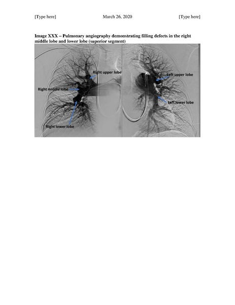 File:Pulmonary Thromboendarterectomy (March 26, 2020).pdf