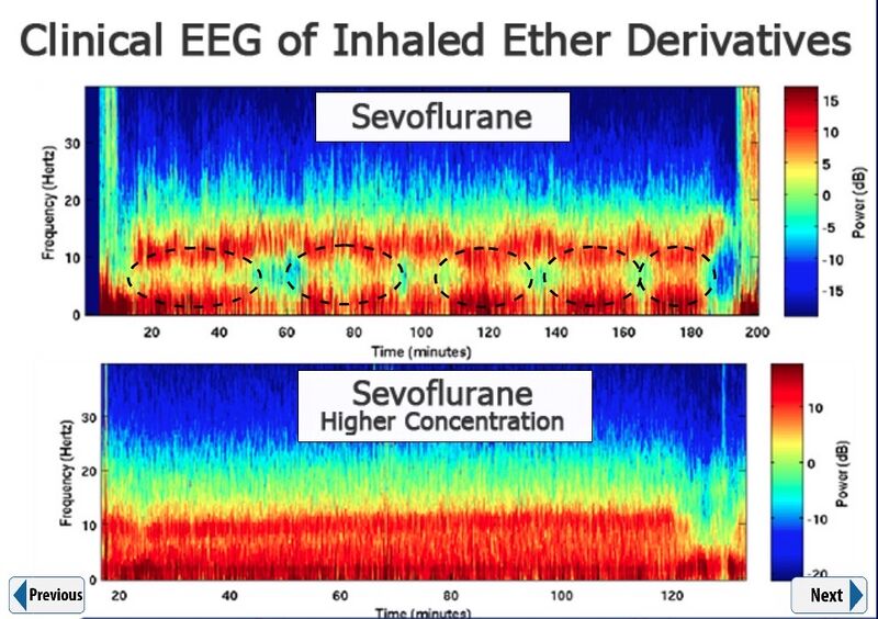 File:Sevoflurane EEG.jpg