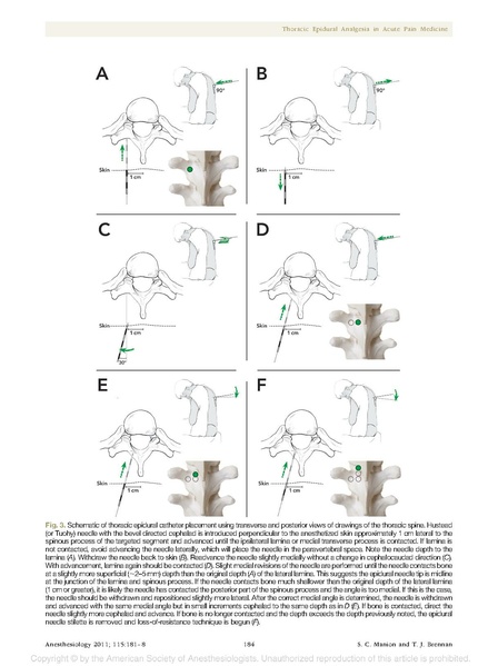 File:Thoracic epidural review (Manion 2011).pdf