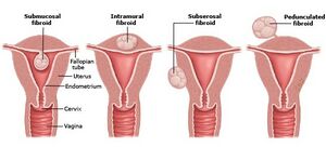 Uterine Myoma Picture.jpg