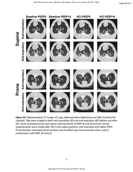 File:Xin AJRCCM 2018 - Ct of prone patients with ARDS.pdf